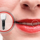 close-up of a woman with a dental implant 