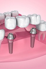 Exploded illustration of dental implants in gum tissue with bridge