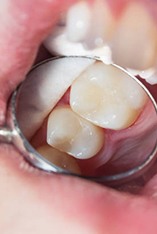 Tooth-colored filling in upper tooth