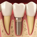 A 3D closeup of a placed dental implant